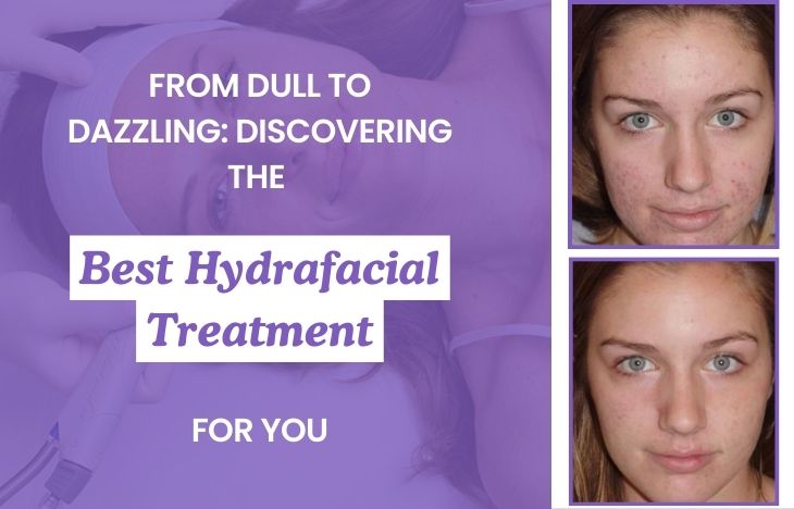 From-Dull-to-Dazzling-Discovering-the-Best-Hydrafacial-Treatment-for-You