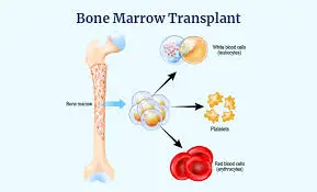 bone marrow transplant cost in india