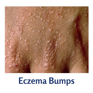 Lifestyle Factors and Hand Eczema Bumps: A Systematic Review