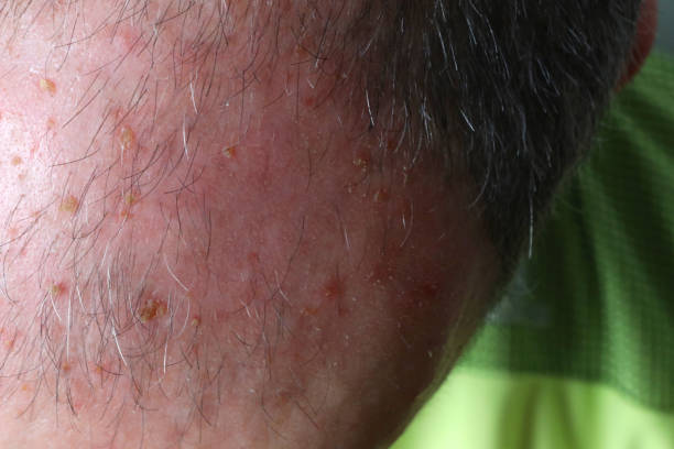 Actinic Keratosis treatment in Abu Dhabi