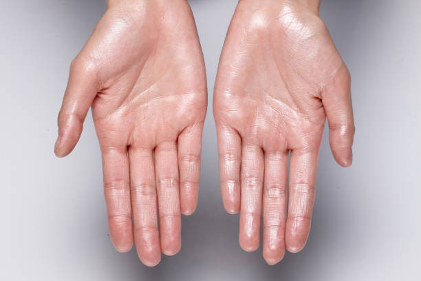 Hyperhidrosis treatment in Abu Dhabi