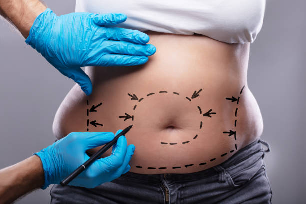 Liposuction in Al Ain