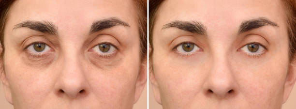 Eye Bag Removal: What You Need to Know in Abu Dhabi