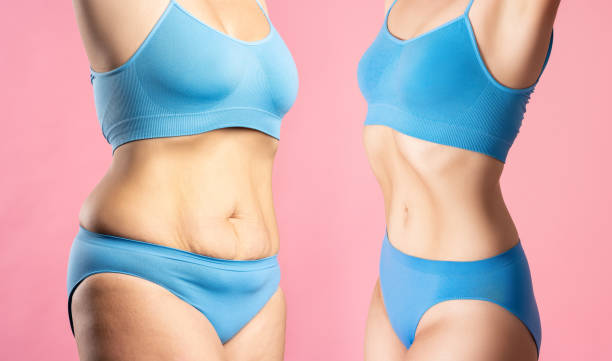 Mini tummy tuck in Abu Dhabi