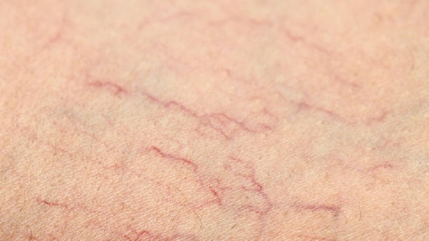 Spider Veins Treatment in Abu Dhabi