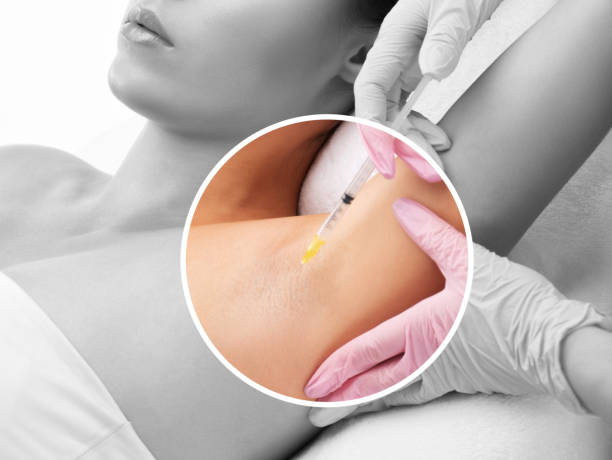 Botox for Hyperhidrosis: A Guide for Abu Dhabi Patients