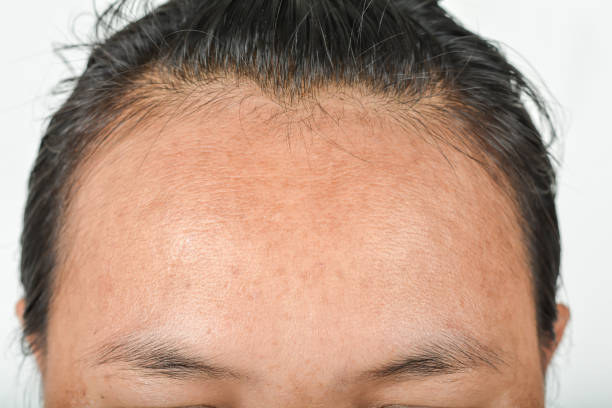 Non-Surgical Actinic Keratosis Removal in Abu Dhabi